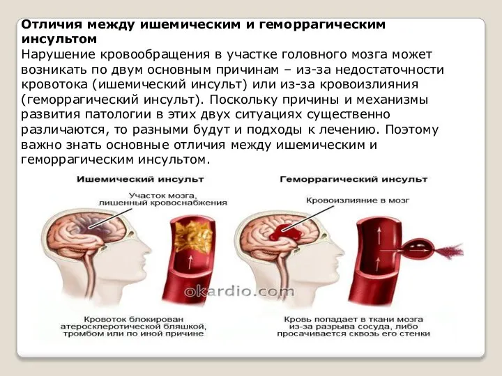 Отличия между ишемическим и геморрагическим инсультом Нарушение кровообращения в участке головного мозга