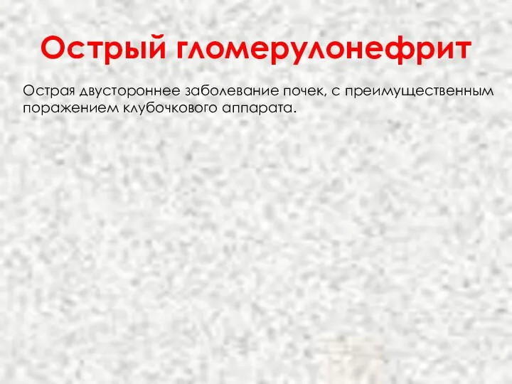 Острый гломерулонефрит Острая двустороннее заболевание почек, с преимущественным поражением клубочкового аппарата.