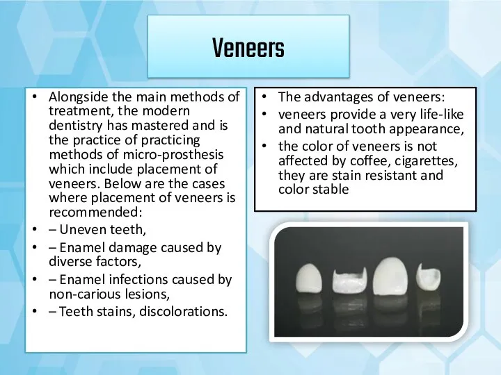 Veneers Alongside the main methods of treatment, the modern dentistry has mastered