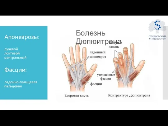 Апоневрозы: лучевой локтевой центральный Фасции: ладонно-пальцевая пальцевая Болезнь Дюпюитрена