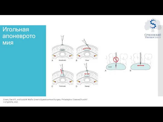 Игольная апоневротомия Green, David P., and Scott W. Wolfe. Green's Operative Hand