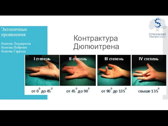 Эктопичные проявления: болезнь Леддерхоза болезнь Пейрони болезнь Гаррода Контрактура Дюпюитрена
