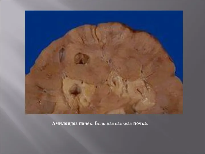 Амилоидоз почек. Большая сальная почка.