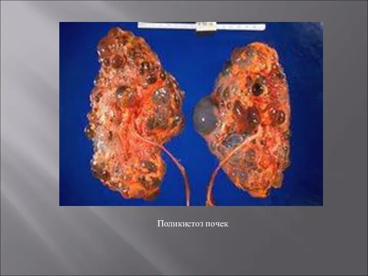 Поликистоз почек
