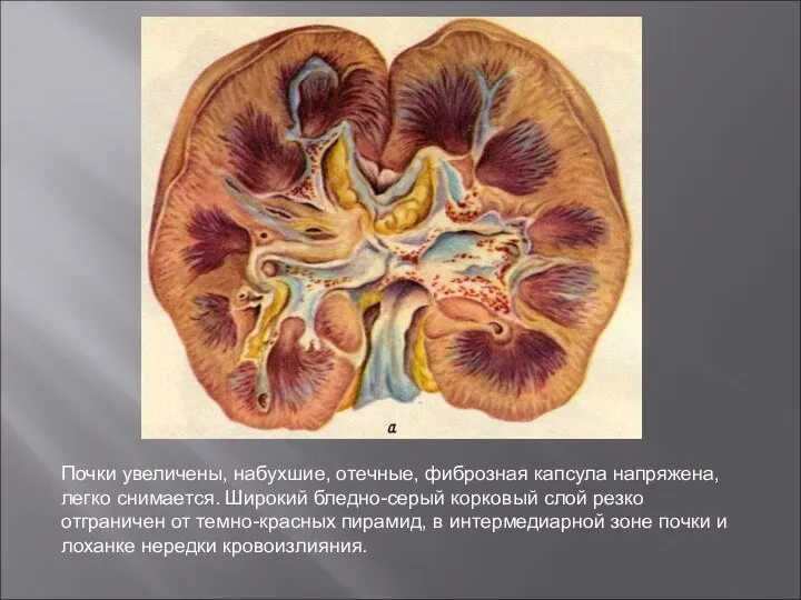 Почки увеличены, набухшие, отечные, фиброзная капсула напряжена, легко снимается. Широкий бледно-серый корковый