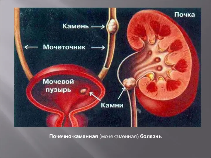 Почечно-каменная (мочекаменная) болезнь