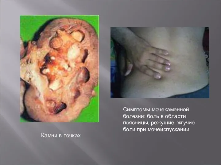 Камни в почках Симптомы мочекаменной болезни: боль в области поясницы, режущие, жгучие боли при мочеиспускании