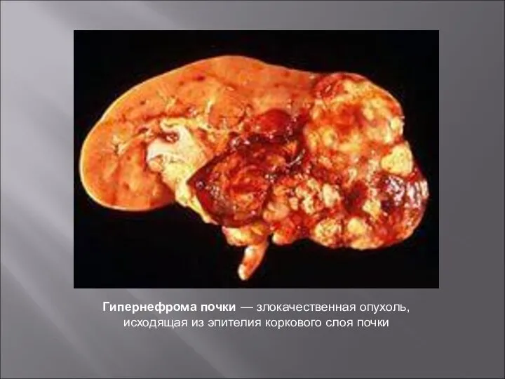Гипернефрома почки — злокачественная опухоль, исходящая из эпителия коркового слоя почки