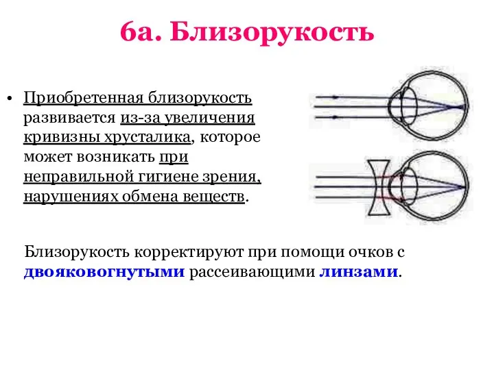 6а. Близорукость Приобретенная близорукость развивается из-за увеличения кривизны хрусталика, которое может возникать