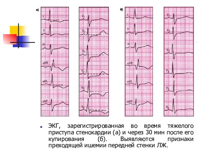 ЭКГ, зарегистрированная во время тяжелого приступа стенокардии (а) и через 30 мин