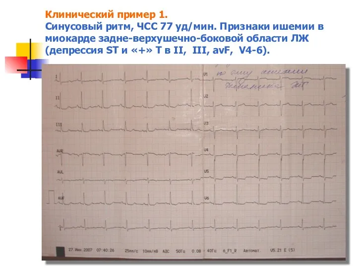 Клинический пример 1. Синусовый ритм, ЧСС 77 уд/мин. Признаки ишемии в миокарде