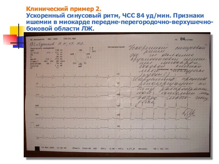 Клинический пример 2. Ускоренный синусовый ритм, ЧСС 84 уд/мин. Признаки ишемии в миокарде передне-перегородочно-верхушечно-боковой области ЛЖ.