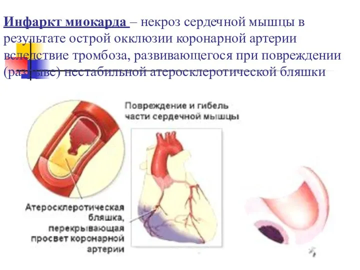 Инфаркт миокарда – некроз сердечной мышцы в результате острой окклюзии коронарной артерии