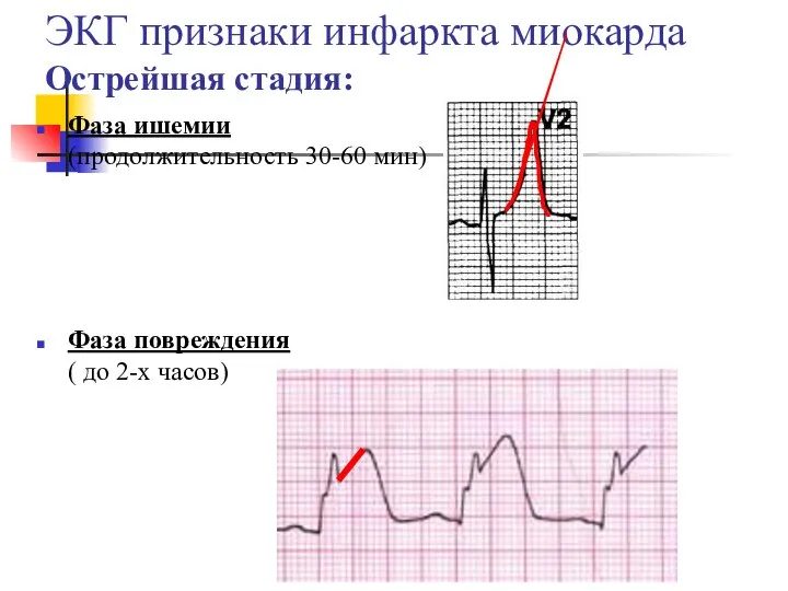 ЭКГ признаки инфаркта миокарда Острейшая стадия: Фаза ишемии (продолжительность 30-60 мин) Фаза