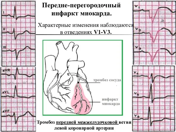 Передне-перегородочный инфаркт миокарда. Характерные изменения наблюдаются в отведениях V1-V3. Тромбоз передней межжелудочковой ветви левой коронарной артерии