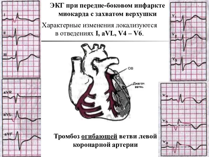 Тромбоз огибающей ветви левой коронарной артерии ЭКГ при передне-боковом инфаркте миокарда с