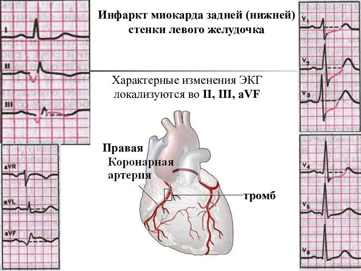 Правая тромб Инфаркт миокарда задней (нижней) стенки левого желудочка Характерные изменения ЭКГ