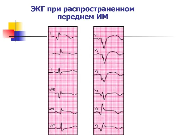 ЭКГ при распространенном переднем ИМ