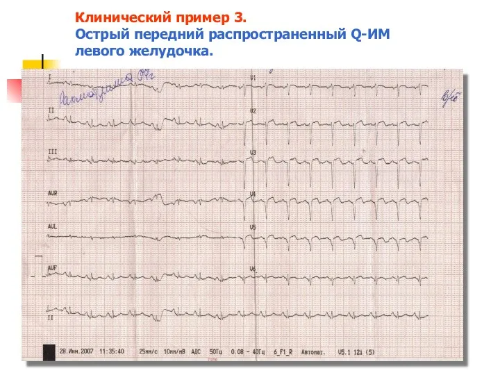 Клинический пример 3. Острый передний распространенный Q-ИМ левого желудочка.