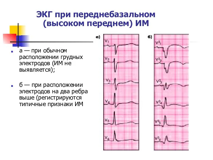 ЭКГ при переднебазальном (высоком переднем) ИМ а — при обычном расположении грудных
