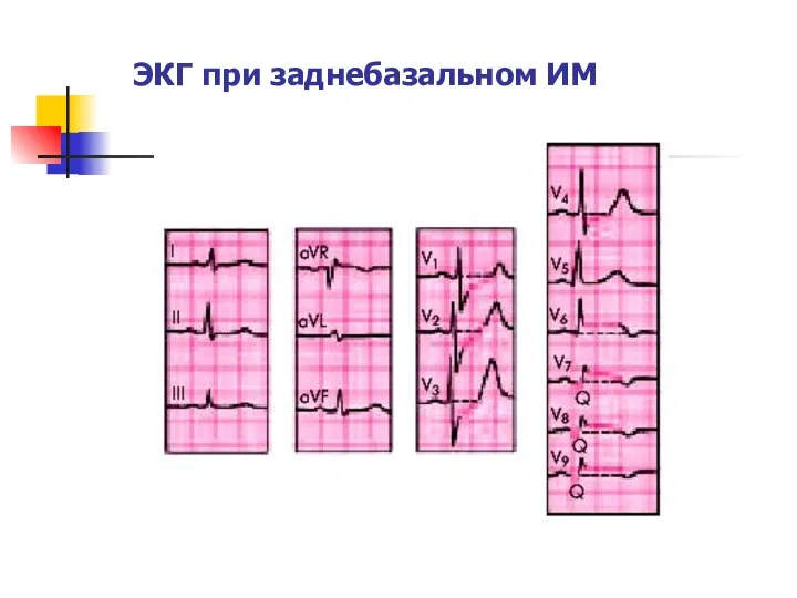 ЭКГ при заднебазальном ИМ