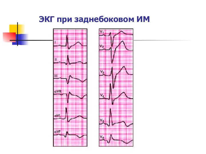 ЭКГ при заднебоковом ИМ