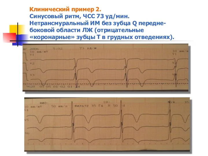 Клинический пример 2. Синусовый ритм, ЧСС 73 уд/мин. Нетрансмуральный ИМ без зубца