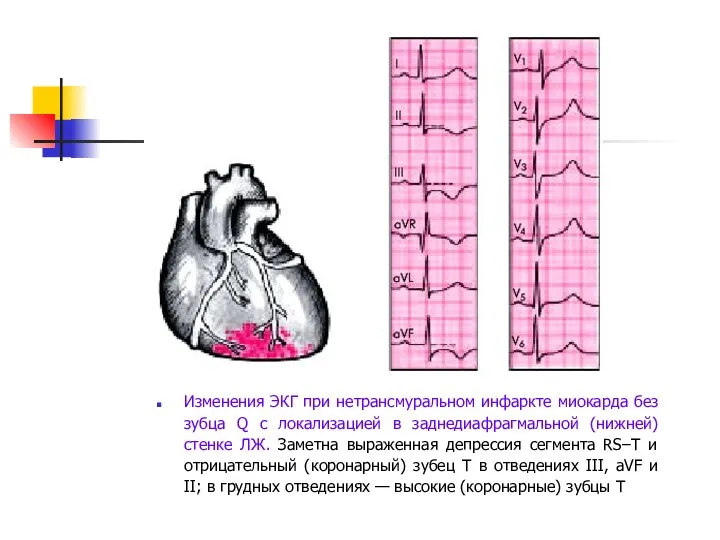Изменения ЭКГ при нетрансмуральном инфаркте миокарда без зубца Q с локализацией в