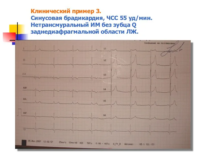 Клинический пример 3. Синусовая брадикардия, ЧСС 55 уд/мин. Нетрансмуральный ИМ без зубца Q заднедиафрагмальной области ЛЖ.