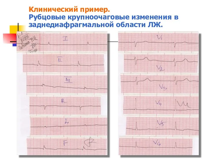 Клинический пример. Рубцовые крупноочаговые изменения в заднедиафрагмальной области ЛЖ.