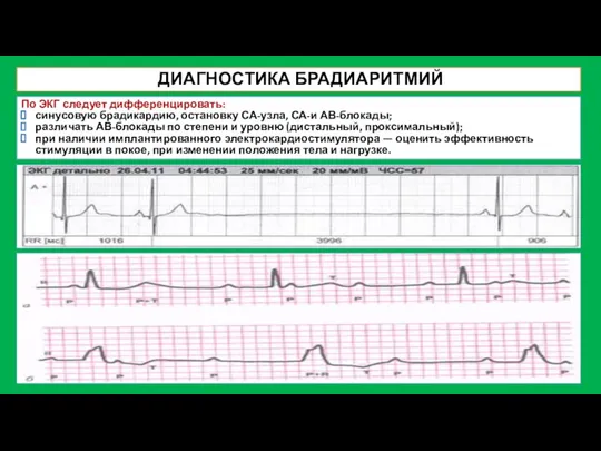 ДИАГНОСТИКА БРАДИАРИТМИЙ По ЭКГ следует дифференцировать: синусовую брадикардию, остановку СА-узла, СА-и АВ-блокады;