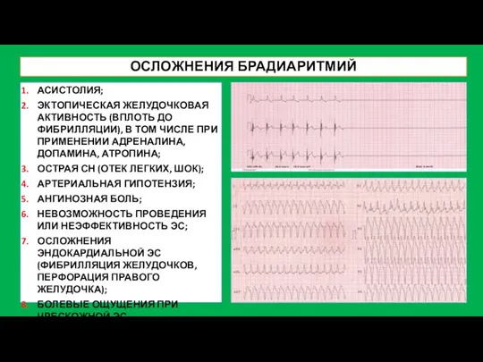 ОСЛОЖНЕНИЯ БРАДИАРИТМИЙ АСИСТОЛИЯ; ЭКТОПИЧЕСКАЯ ЖЕЛУДОЧКОВАЯ АКТИВНОСТЬ (ВПЛОТЬ ДО ФИБРИЛЛЯЦИИ), В ТОМ ЧИСЛЕ