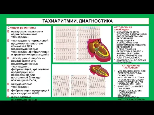 ТАХИАРИТМИИ, ДИАГНОСТИКА Следует различать: непароксизмальные и пароксизмальные тахикардии; тахикардии с нормальной продолжительностью