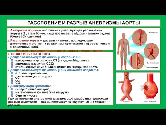 РАССЛОЕНИЕ И РАЗРЫВ АНЕВРИЗМЫ АОРТЫ Аневризма аорты — постоянно существующее расширение аорты