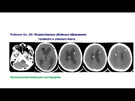 Ребенок 6л. DS: Множественные объёмные образования головного и спинного мозга. Вентрикулоперитонеальное шунтирование.