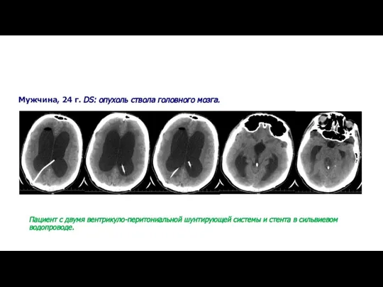 Мужчина, 24 г. DS: опухоль ствола головного мозга. Пациент с двумя вентрикуло-перитониальной