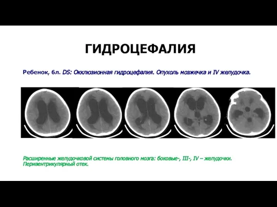 ГИДРОЦЕФАЛИЯ Ребенок, 6л. DS: Окклюзионная гидроцефалия. Опухоль мозжечка и IV желудочка. Расширенные