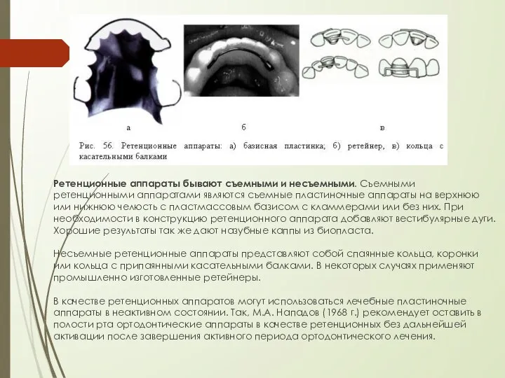 Ретенционные аппараты бывают съемными и несъемными. Съемными ретенционными аппаратами являются съемные пластиночные