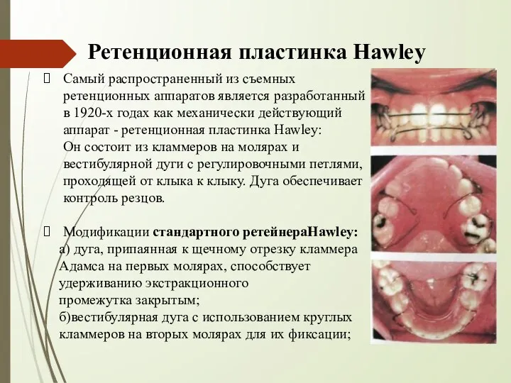 Самый распространенный из съемных ретенционных аппаратов является разработанный в 1920-х годах как