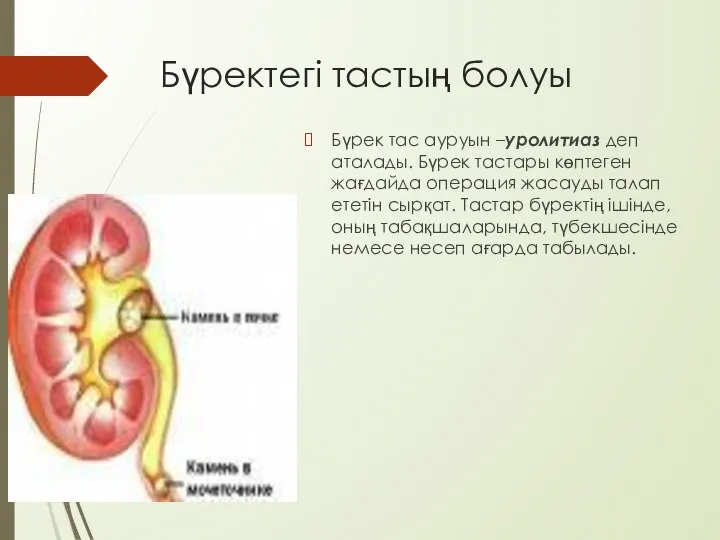 Бүректегі тастың болуы Бүрек тас ауруын –уролитиаз деп аталады. Бүрек тастары көптеген