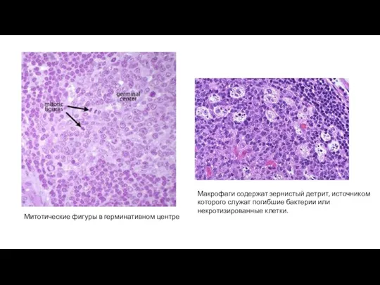 Митотические фигуры в герминативном центре Макрофаги содержат зернистый детрит, источником которого служат