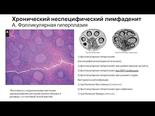 Хронический неспецифический лимфаденит А. Фолликулярная гиперплазия Фолликулы с выраженными светлыми зародышевыми центрами