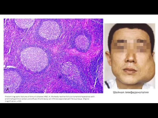 Photomicrographic features of Kimura’s disease (H&E). A. Markedly reactive follicular lymphoid hyperplasia
