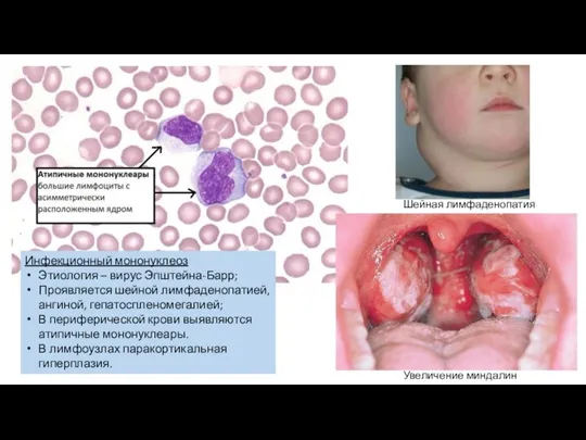Инфекционный мононуклеоз Этиология – вирус Эпштейна-Барр; Проявляется шейной лимфаденопатией, ангиной, гепатоспленомегалией; В