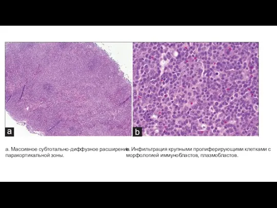 b. Инфильтрация крупными пролиферирующими клетками с морфологией иммунобластов, плазмобластов. а. Массивное субтотально-диффузное расширение паракортикальной зоны.