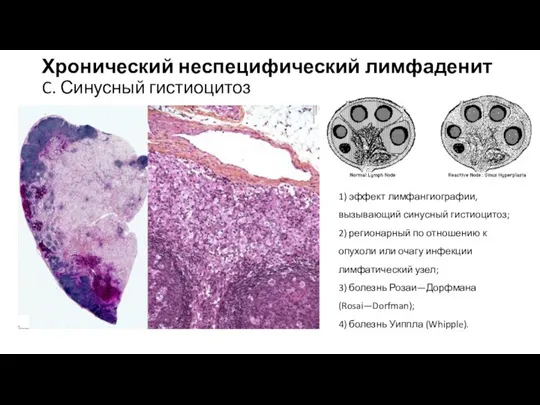 Хронический неспецифический лимфаденит C. Синусный гистиоцитоз 1) эффект лимфангиографии, вызывающий синусный гистиоцитоз;