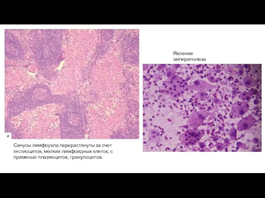 Синусы лимфоузла перерастянуты за счет гистиоцитов, мелких лимфоидных клеток, с примесью плазмоцитов, гранулоцитов. Явление эмпериполеза