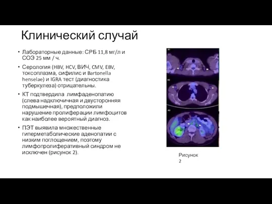 Клинический случай Рисунок 2 Лабораторные данные: СРБ 11,8 мг/л и СОЭ 25