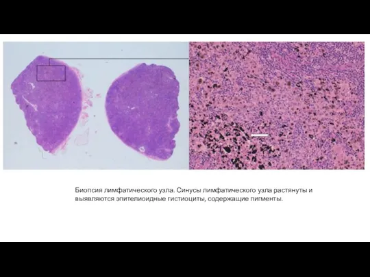 Биопсия лимфатического узла. Синусы лимфатического узла растянуты и выявляются эпителиоидные гистиоциты, содержащие пигменты.