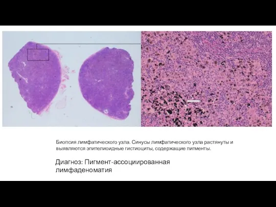 Биопсия лимфатического узла. Синусы лимфатического узла растянуты и выявляются эпителиоидные гистиоциты, содержащие пигменты. Диагноз: Пигмент-ассоциированная лимфаденоматия